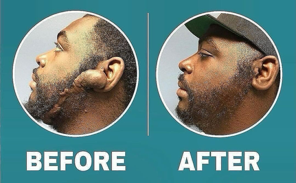 Keloid Dissolver Oil